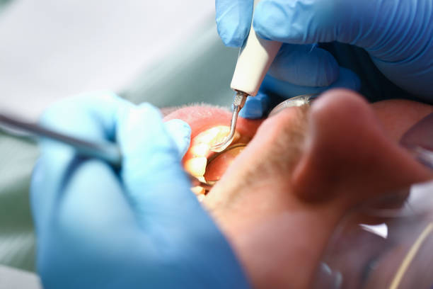 Best Emergency Wisdom Tooth Extraction in Roseville, MN