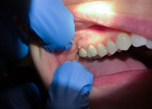 Best Dental Abscess Treatment in Roseville, MN